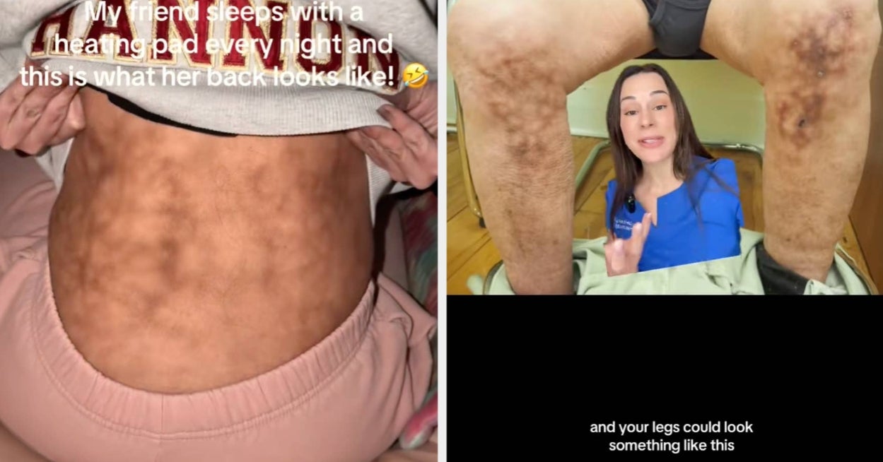 This Woman's Heating Pad Horror Story Has Left Nearly 50 Million People Stunned