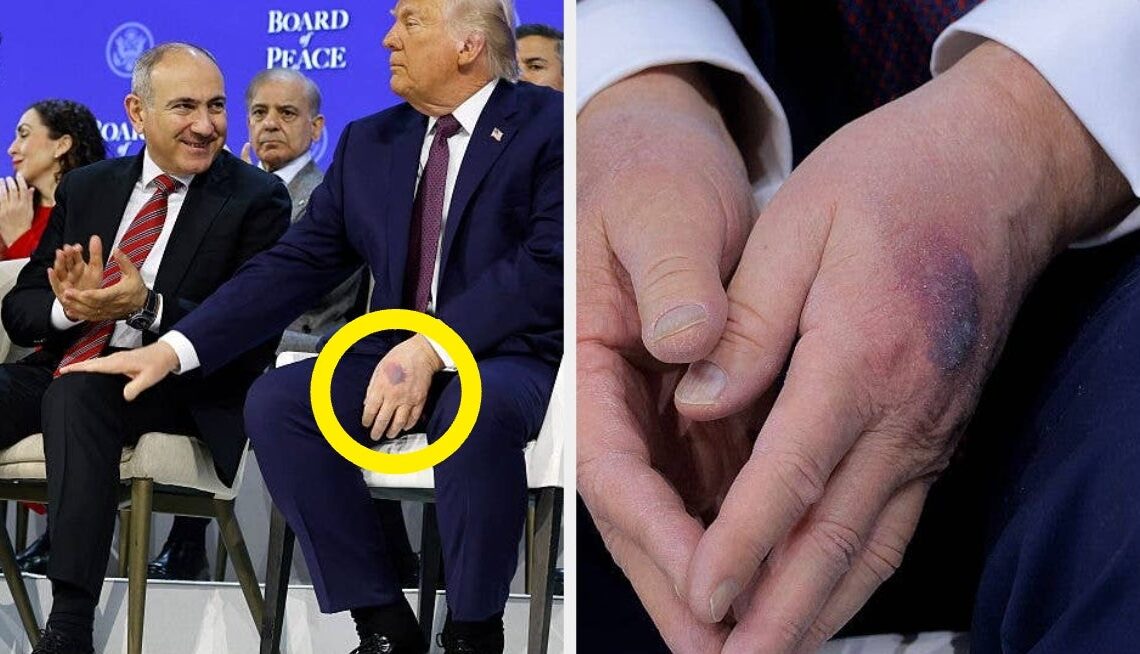 Trump’s Explanation For That New Hand Bruise Is Raising A Lot Of Eyebrows